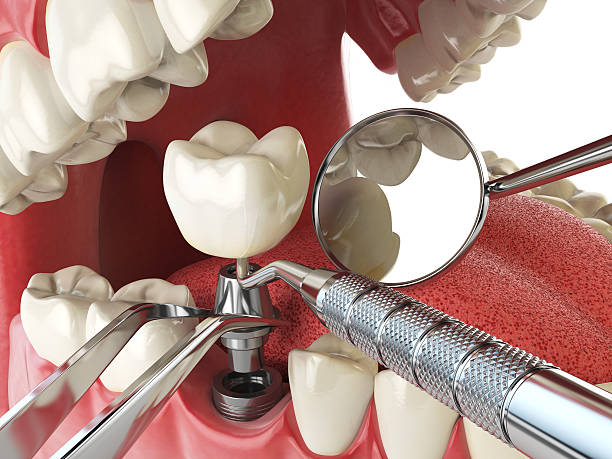 Best Urgent Tooth Repair  in Osgood, IN